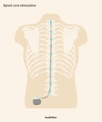 Spinal Cord Stimulation